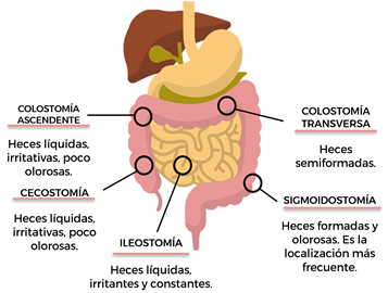 Manejo, Cuidado y Educación para Ostomizados - 2