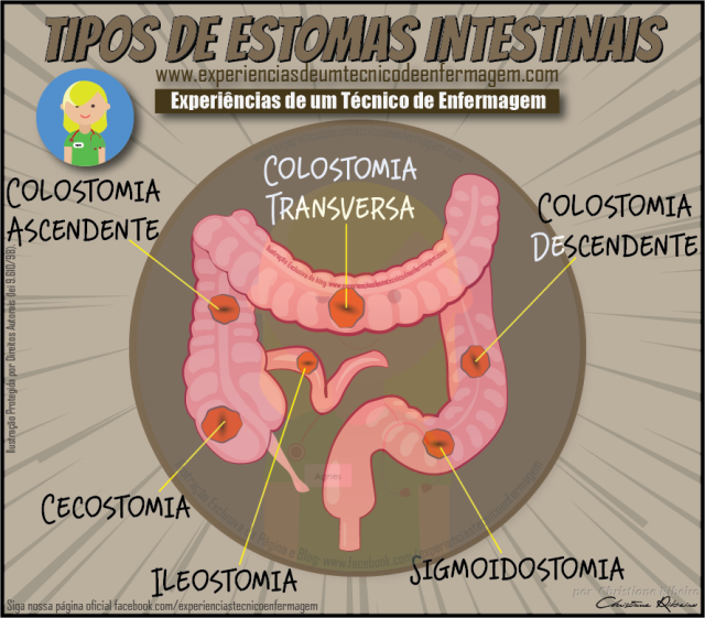 Manejo, Cuidado y Educación para Ostomizados - 6