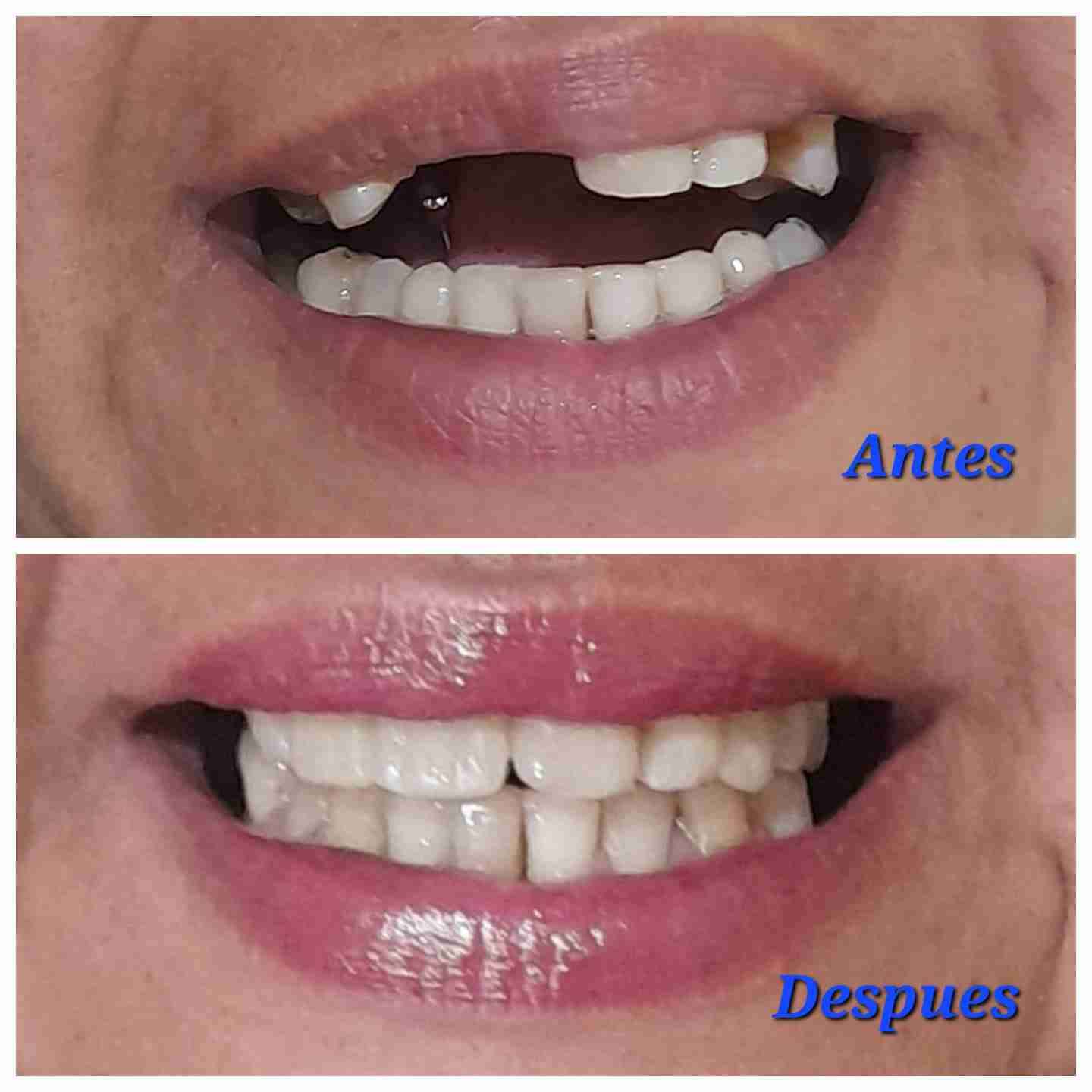 Servicios de prótesis dentales a domicilio - miniatura 2