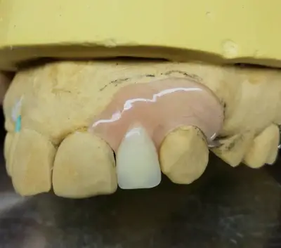 Prótesis dentales hacemos envios - miniatura 1