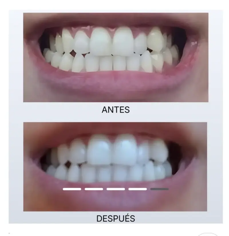 Kit blanqueador dental efectivo - 1