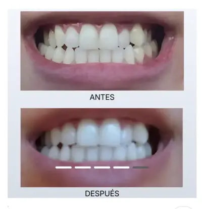 Kit blanqueador dental efectivo - miniatura 1