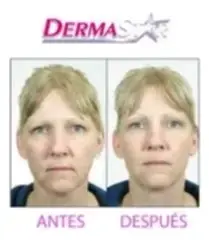 Dispositivo de rejuvenecimiento facial DermaWand - 3