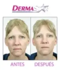 Dispositivo de rejuvenecimiento facial DermaWand - miniatura 3