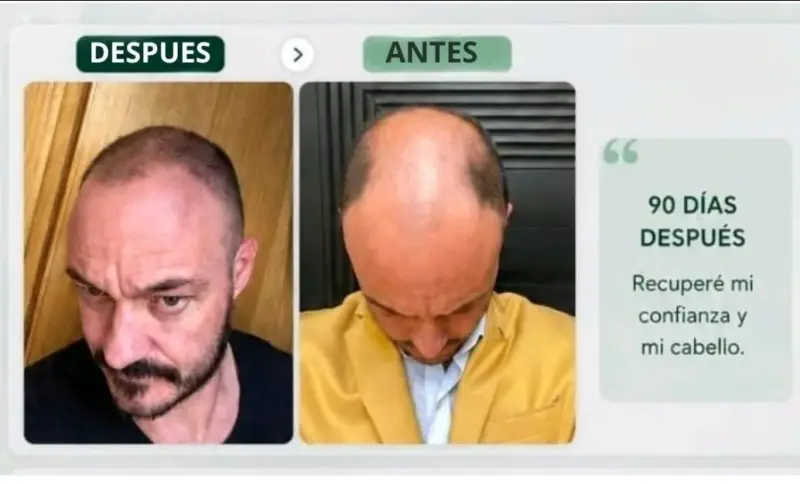 Kit de Cuidado Capilar Botalab para Crecimiento - 1