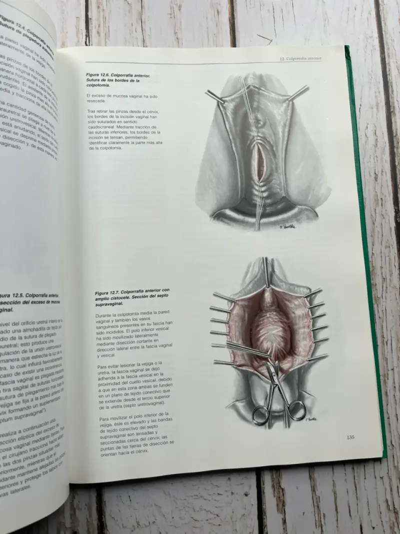 Operaciones por Vía Vaginal de Reiffenstuhl - 5