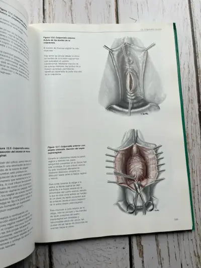Operaciones por Vía Vaginal de Reiffenstuhl - miniatura 5