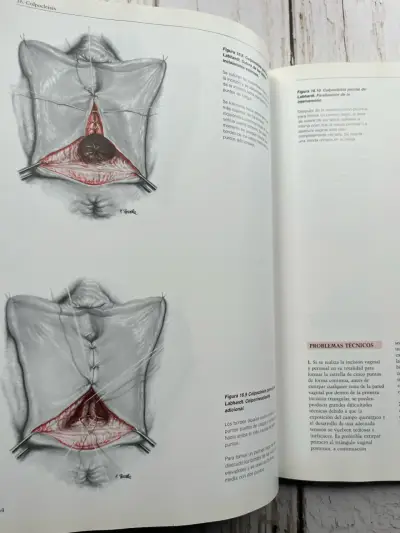 Operaciones por Vía Vaginal de Reiffenstuhl - miniatura 6