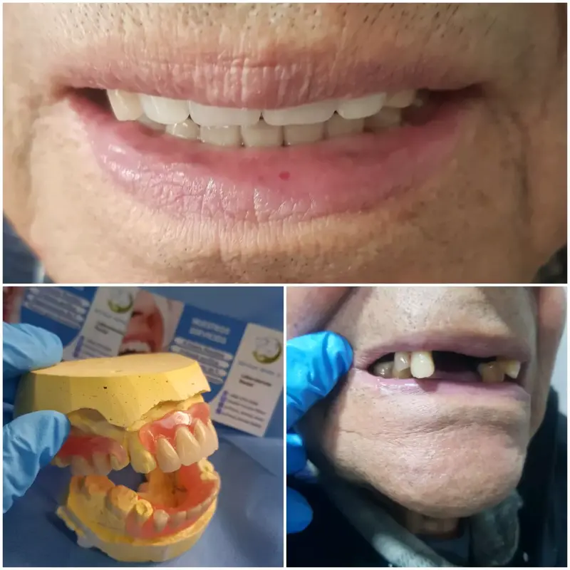 Prótesis dental removible para adultos - 1