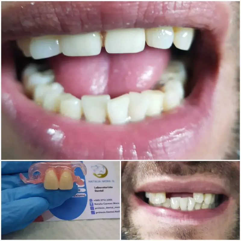 Prótesis dental removible para adultos - 3