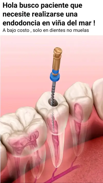 Servicio de endodoncia en Viña del Mar - miniatura 1